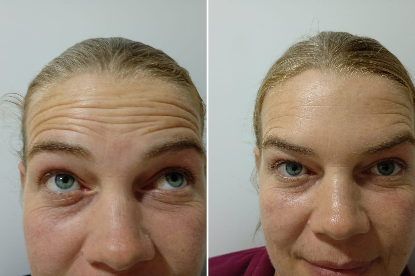 Antes e depois de Toxina Botulínica nas linhas da testa ao levantar as sobrancelhas na OligoVitta Limeira