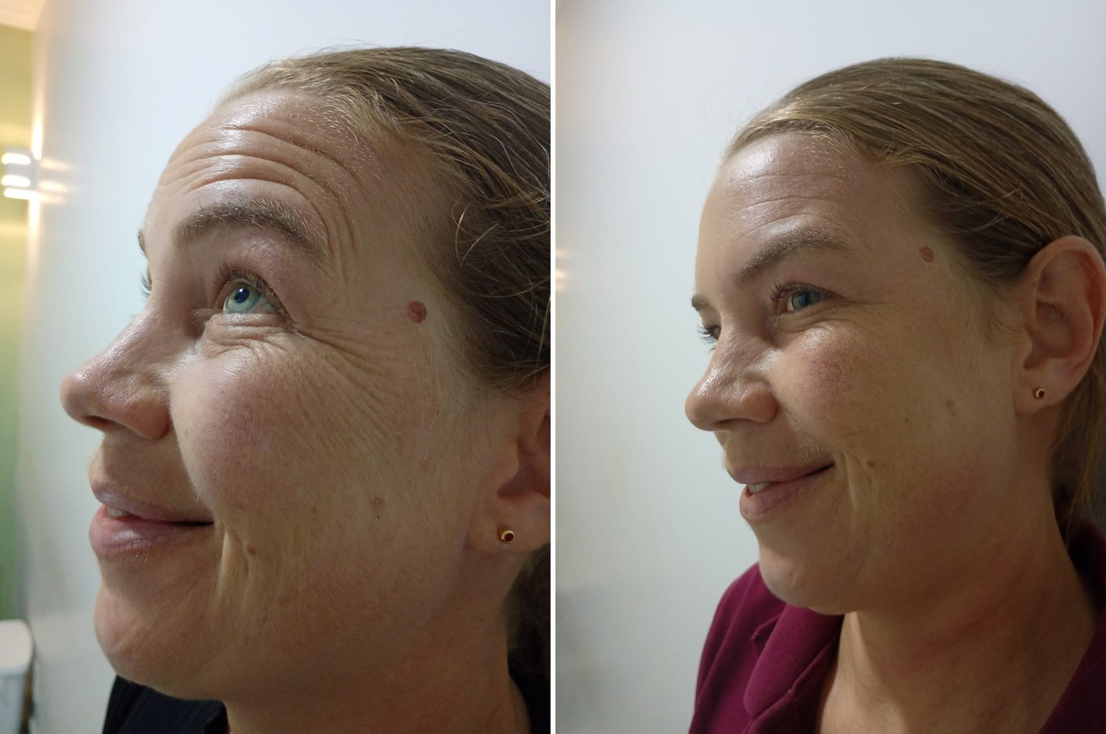 Antes e depois de Toxina Botulínica nos pés de galinha ao redor dos olhos na OligoVitta Limeira