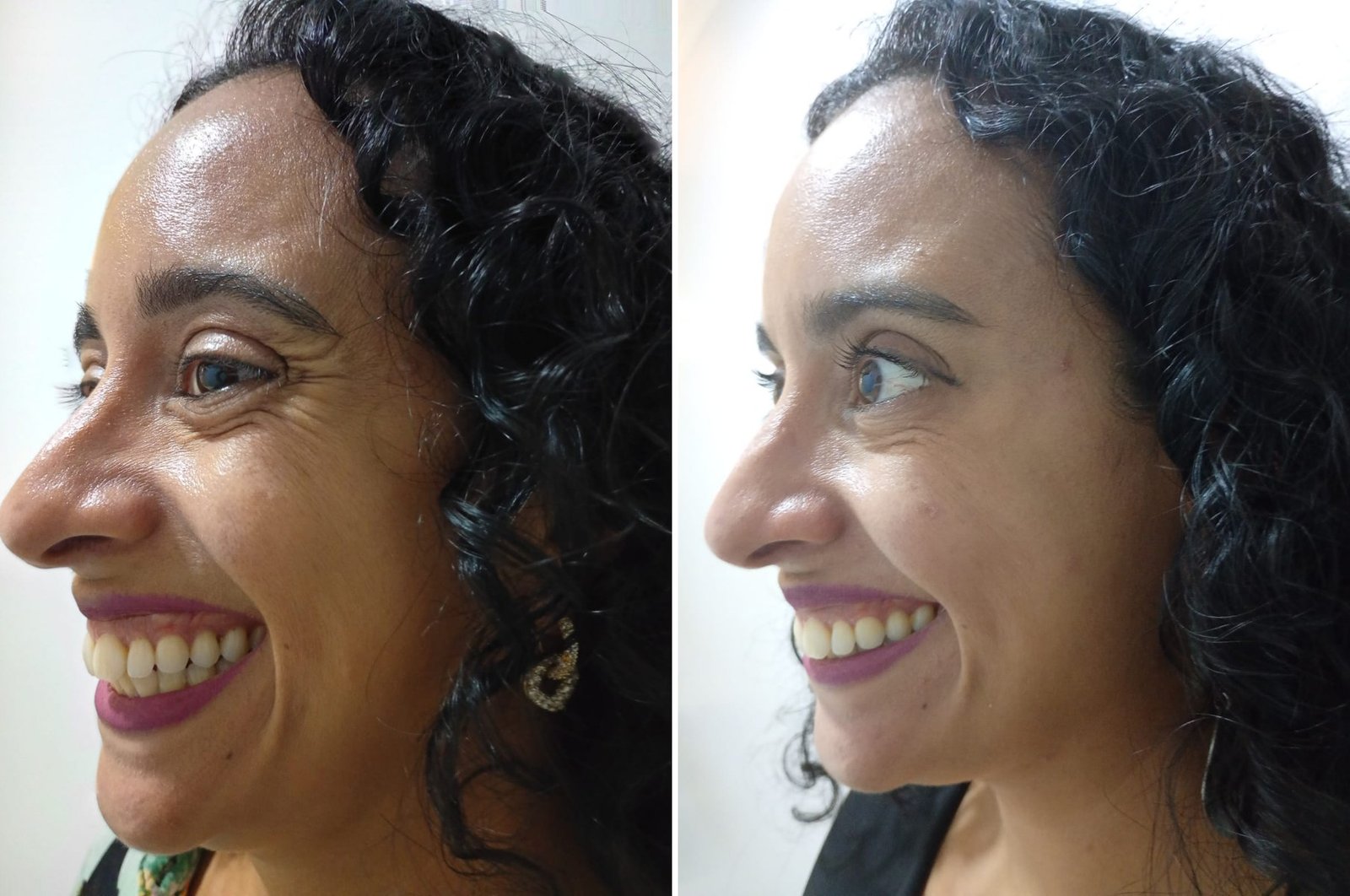 Antes e depois de Toxina Botulínica nas marcas de expressão ao sorrir na OligoVitta Limeira