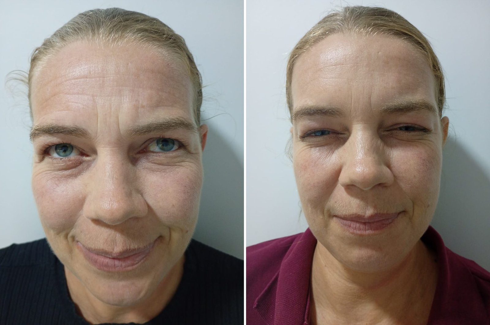 Antes e depois de Toxina Botulínica na testa e na ruga entre as sobrancelhas na OligoVitta Limeira