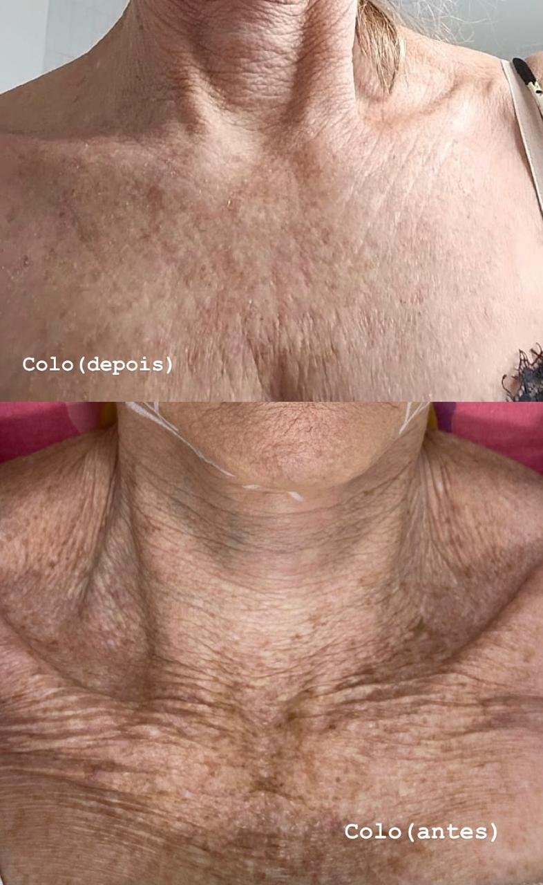 Antes e depois de Laser Etherea no colo, com redução de rugas e manchas, na OligoVitta Limeira