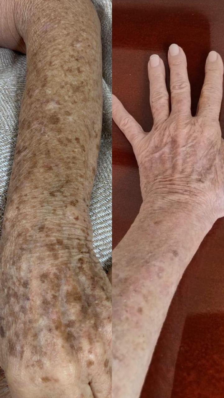 Antes e depois de Laser Etherea em manchas senis no braço e na mão na OligoVitta Limeira