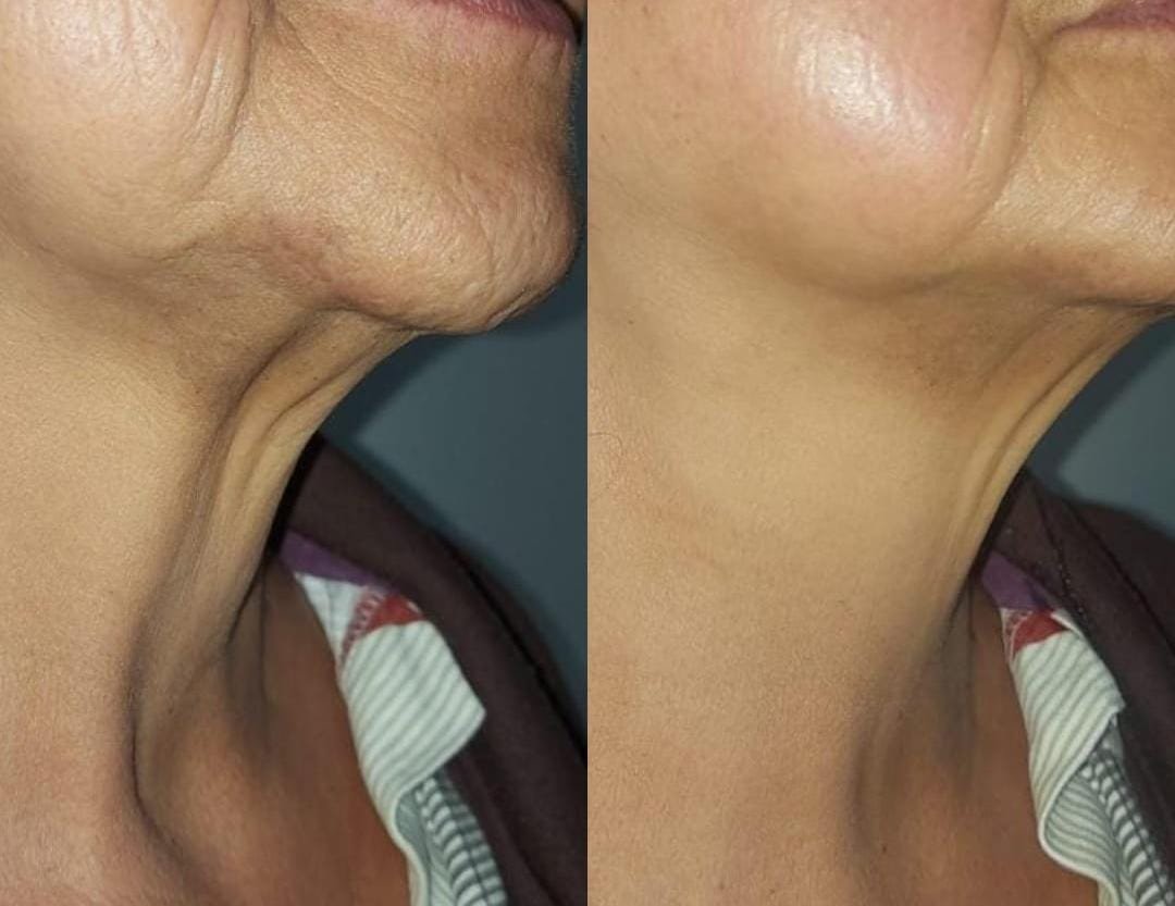 Antes e depois de Laser Etherea no pescoço, com pele mais firme e lisa, na OligoVitta Limeira