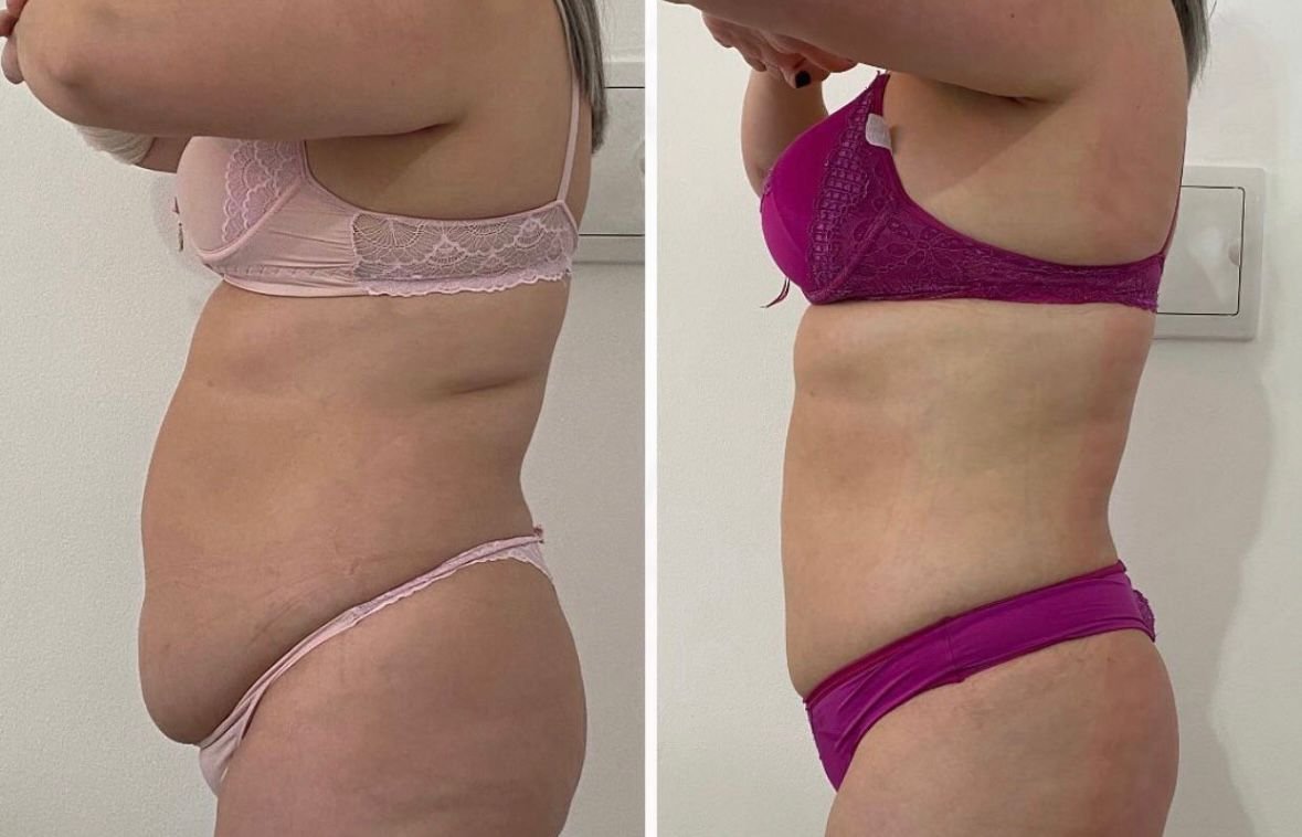 Antes e depois de Lipo sem Corte no abdômen feminino na OligoVitta Limeira
