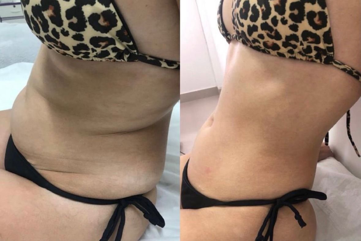 Antes e depois de Lipo sem Corte na cintura e flancos femininos na OligoVitta Limeira