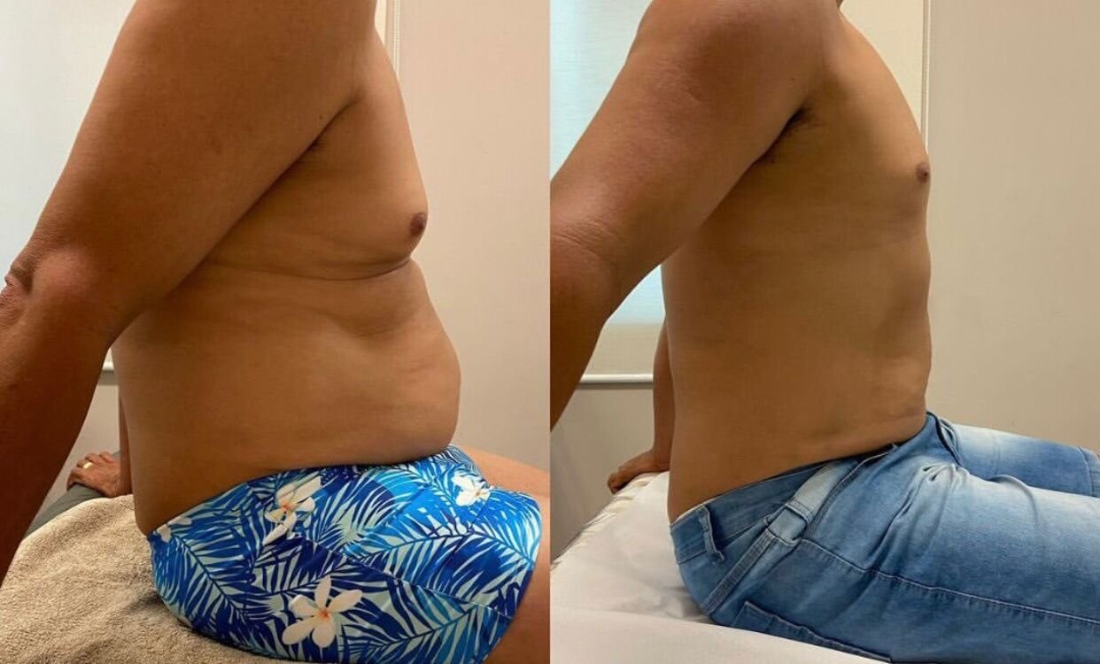 Antes e depois de Lipo sem Corte no abdômen masculino na OligoVitta Limeira