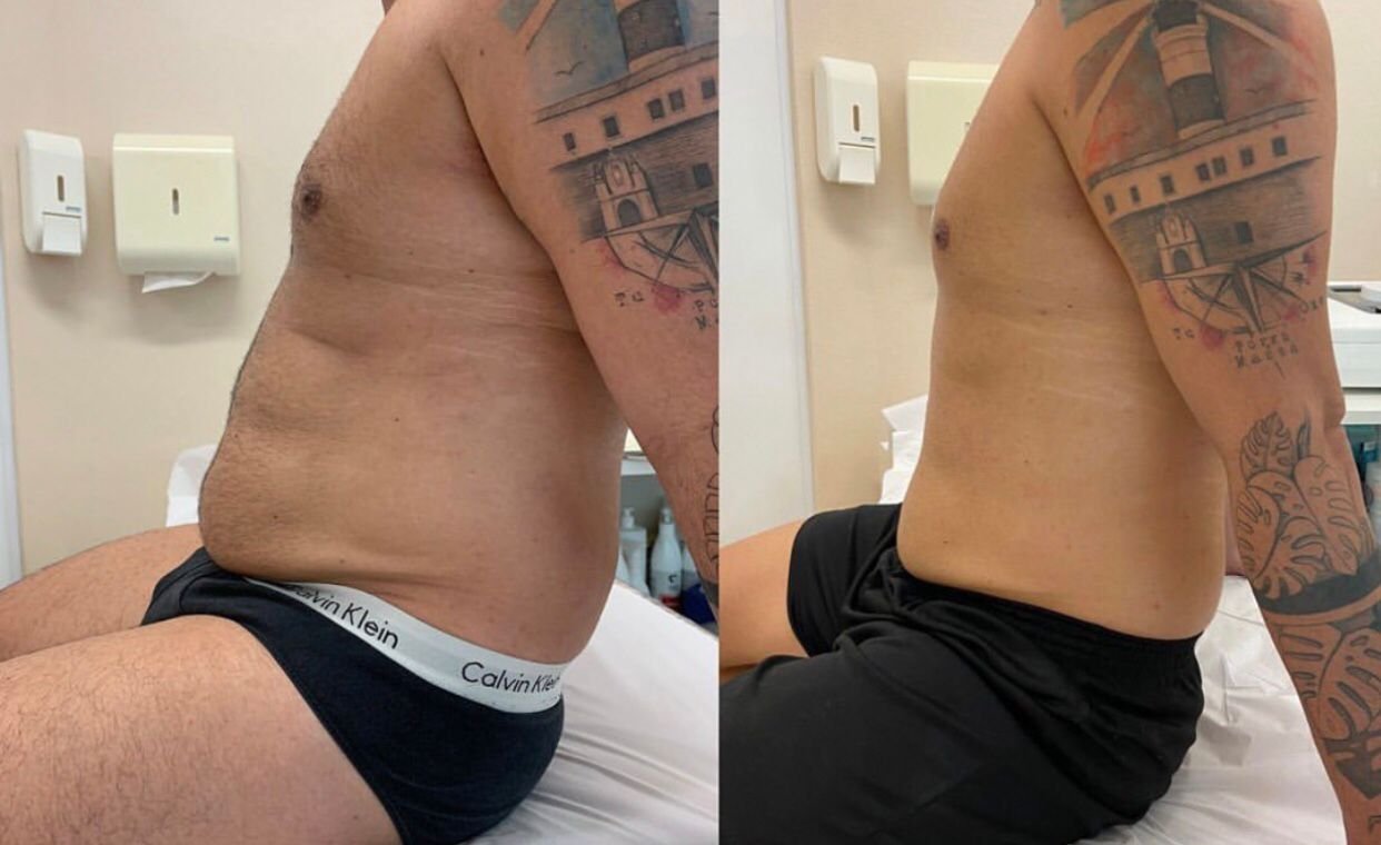 Antes e depois de Lipo sem Corte em gordura localizada no abdômen masculino na OligoVitta Limeira