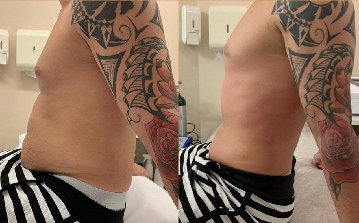 Antes e depois de Lipo sem Corte no abdômen e flancos masculinos na OligoVitta Limeira