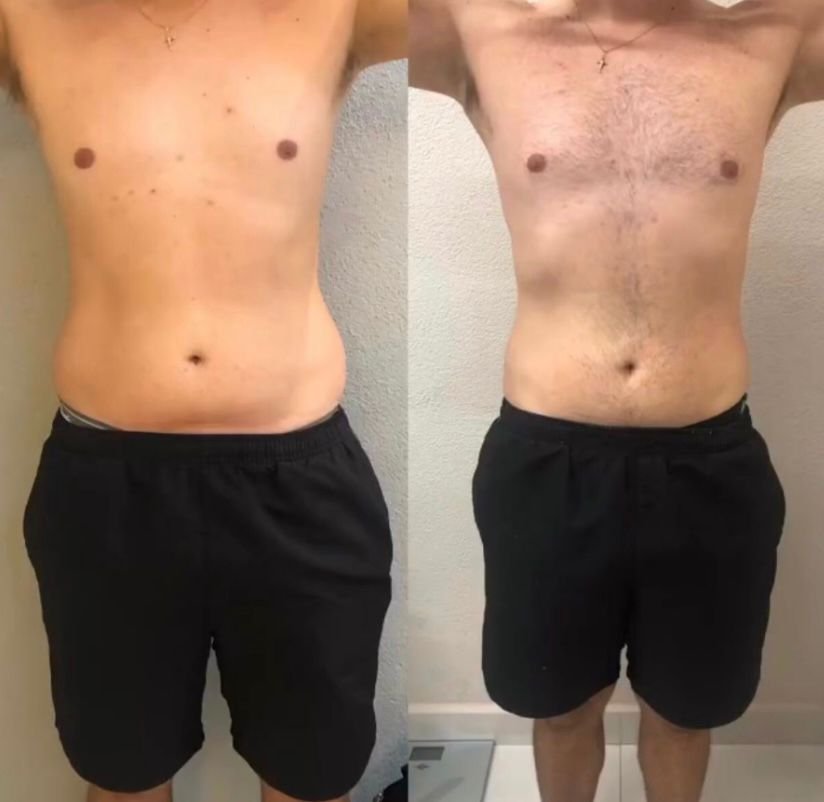 Antes e depois de Lipo sem Corte com vista frontal do abdômen na OligoVitta Limeira